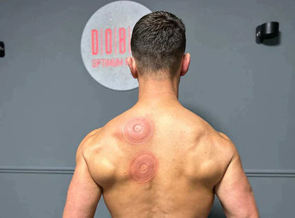 Restore Cupping Device